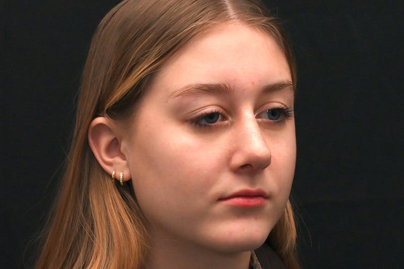 Rhinoplasty Before & After Gallery - Patient 389722 - Image 4
