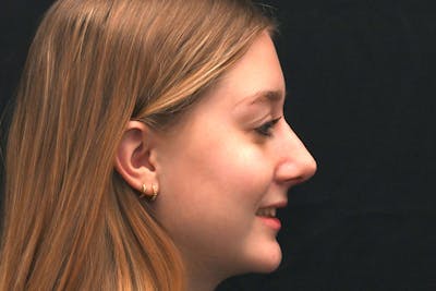 Rhinoplasty Before & After Gallery - Patient 389722 - Image 2