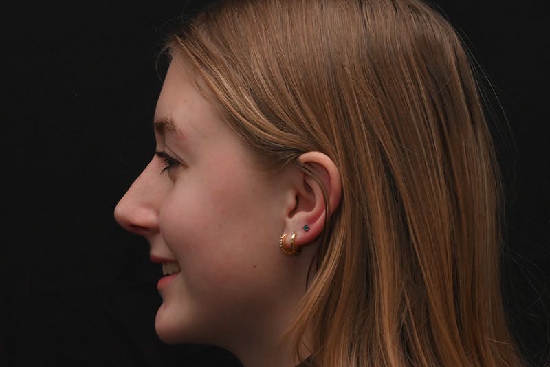 Rhinoplasty Before & After Gallery - Patient 389722 - Image 10