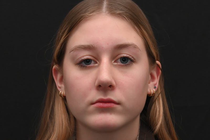 Rhinoplasty Before & After Gallery - Patient 389722 - Image 6