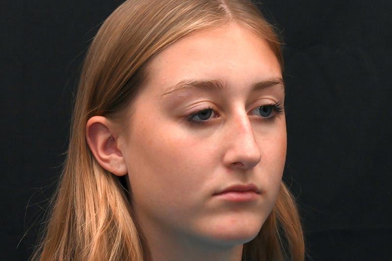 Rhinoplasty Before & After Gallery - Patient 389722 - Image 3
