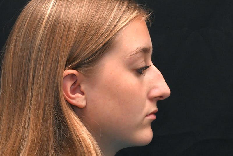 Rhinoplasty Before & After Gallery - Patient 389722 - Image 1