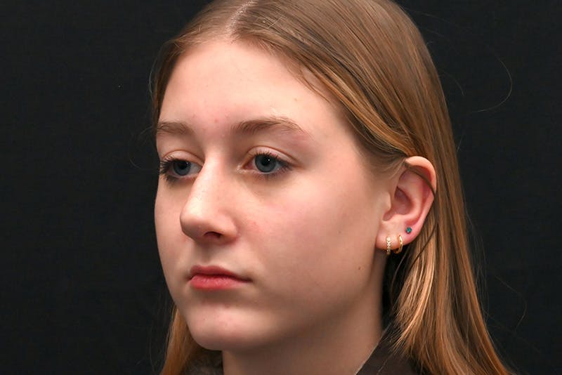 Rhinoplasty Before & After Gallery - Patient 389722 - Image 8