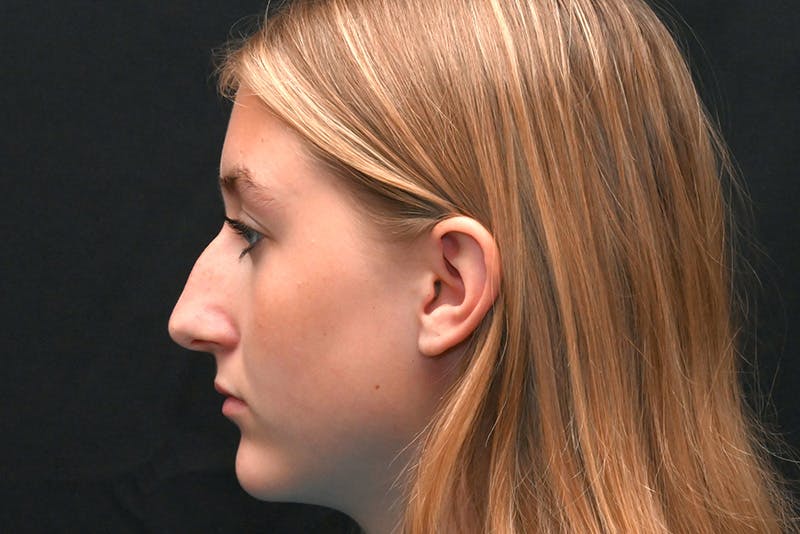 Rhinoplasty Before & After Gallery - Patient 389722 - Image 9