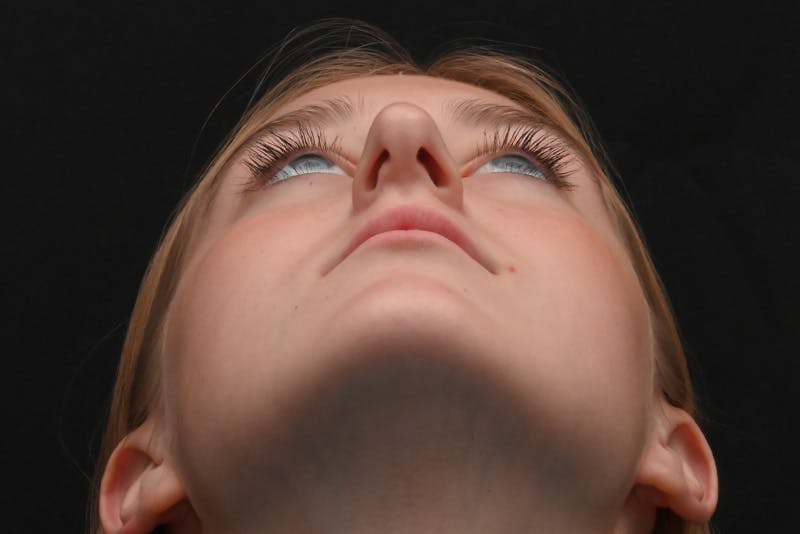 Rhinoplasty Before & After Gallery - Patient 389722 - Image 11