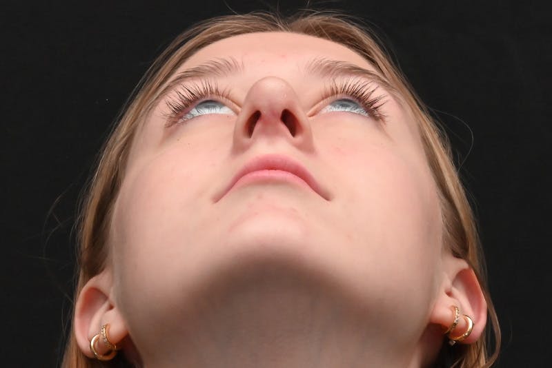 Rhinoplasty Before & After Gallery - Patient 389722 - Image 12