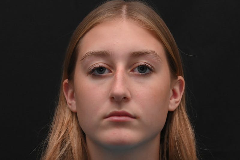 Rhinoplasty Before & After Gallery - Patient 389722 - Image 5