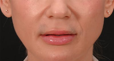 Lip Lift Before & After Gallery - Patient 375546 - Image 1