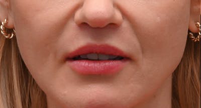 Lip Lift Before & After Gallery - Patient 375546 - Image 2