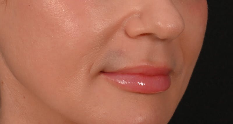 Lip Lift Before & After Gallery - Patient 375546 - Image 3