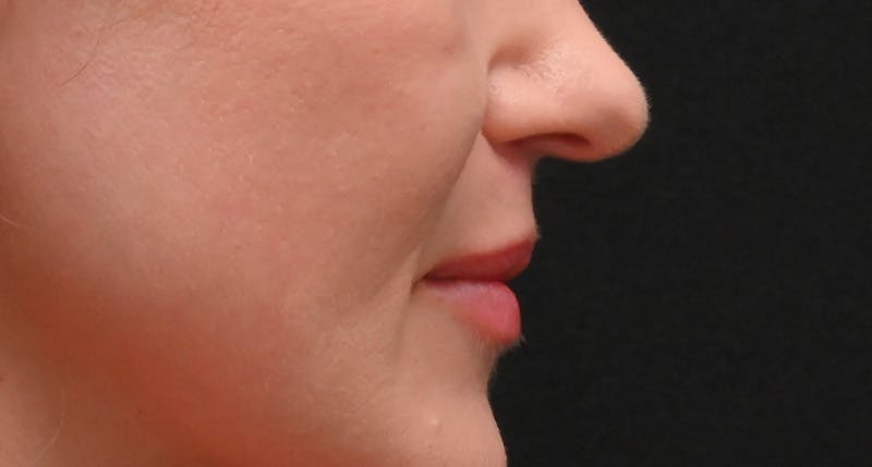 Lip Lift Before & After Gallery - Patient 375546 - Image 6
