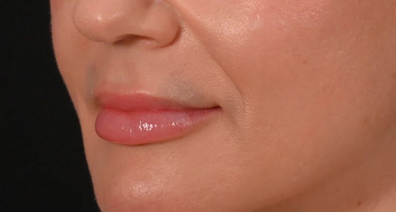 Lip Lift Before & After Gallery - Patient 375546 - Image 7