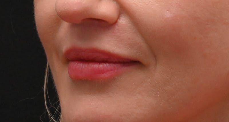 Lip Lift Before & After Gallery - Patient 375546 - Image 8