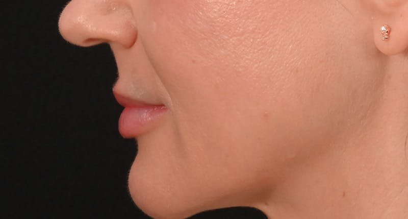 Lip Lift Before & After Gallery - Patient 375546 - Image 9