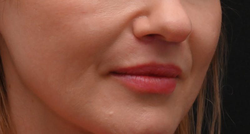 Lip Lift Before & After Gallery - Patient 375546 - Image 4