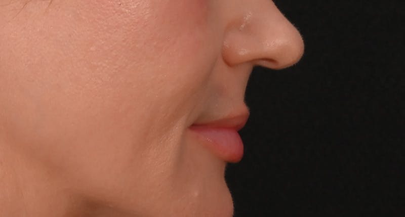 Lip Lift Before & After Gallery - Patient 375546 - Image 5