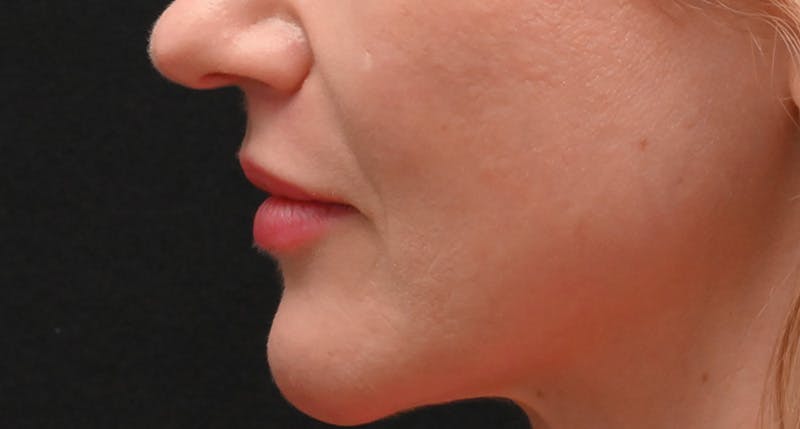 Lip Lift Before & After Gallery - Patient 375546 - Image 10