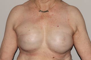 Breast Reconstruction Revision Before & After Gallery - Patient 413120 - Image 2