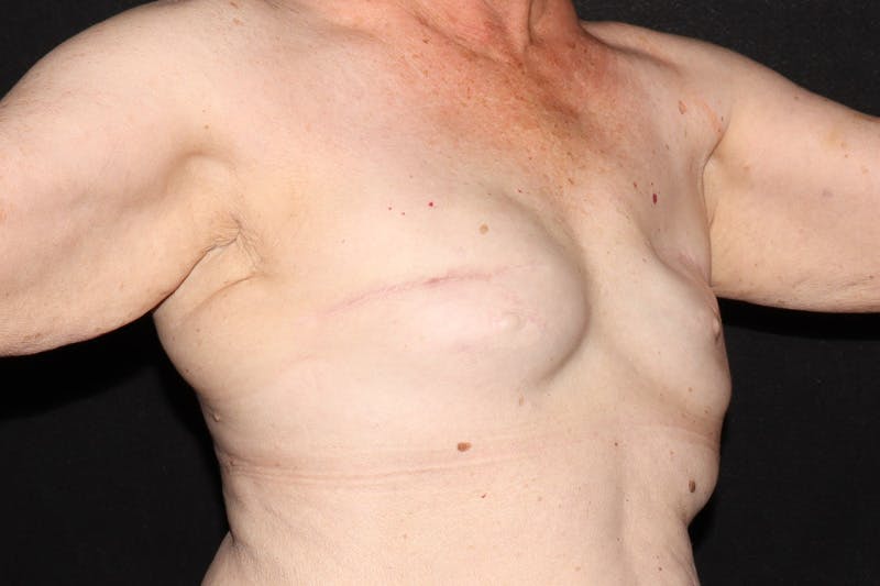 Breast Reconstruction Revision Before & After Gallery - Patient 413120 - Image 3