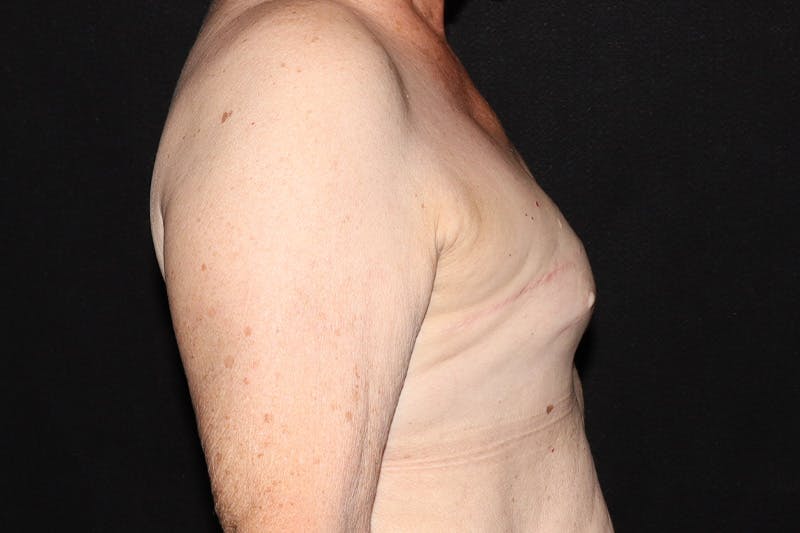 Breast Reconstruction Revision Before & After Gallery - Patient 413120 - Image 5