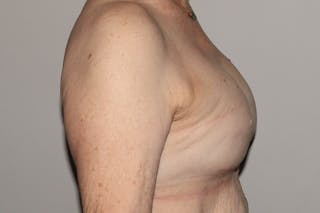 Breast Reconstruction Revision Before & After Gallery - Patient 413120 - Image 6