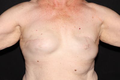 Breast Reconstruction Revision Before & After Gallery - Patient 413120 - Image 1