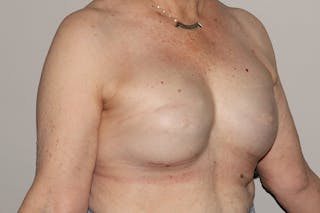 Breast Reconstruction Revision Before & After Gallery - Patient 413120 - Image 4