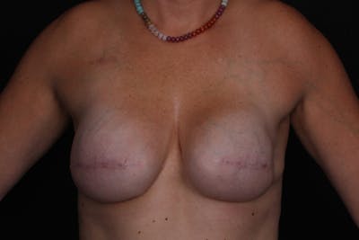 Breast Reconstruction Revision Before & After Gallery - Patient 116715 - Image 1