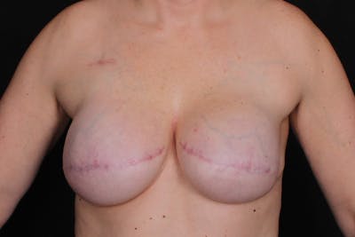 Breast Reconstruction Revision Before & After Gallery - Patient 116715 - Image 2