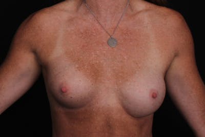 Breast Reconstruction Revision Before & After Gallery - Patient 248498 - Image 1