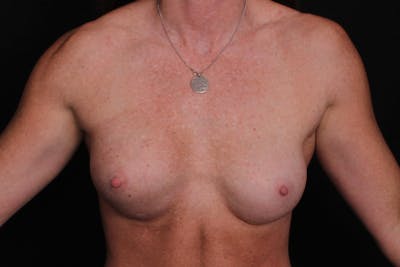 Breast Reconstruction Revision Before & After Gallery - Patient 248498 - Image 2