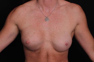 Breast Reconstruction Revision Before & After Gallery - Patient 248498 - Image 2