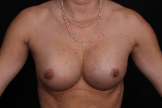 Breast Implant Revision Before & After Gallery - Patient 389816 - Image 2