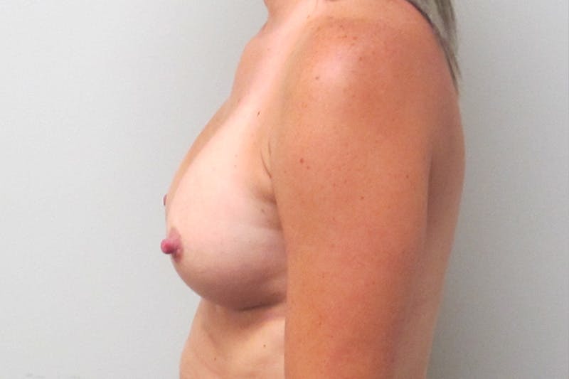 Breast Implant Revision Before & After Gallery - Patient 389816 - Image 5