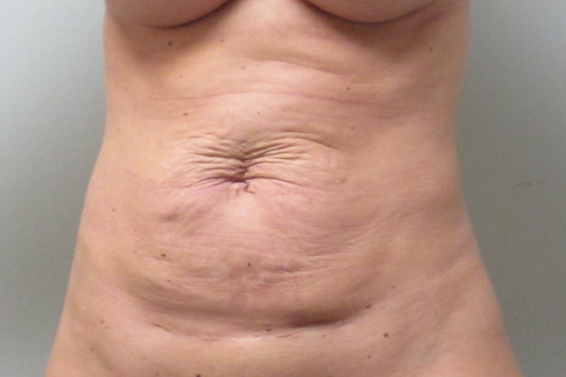Abdominoplasty Before & After Gallery - Patient 102311 - Image 1