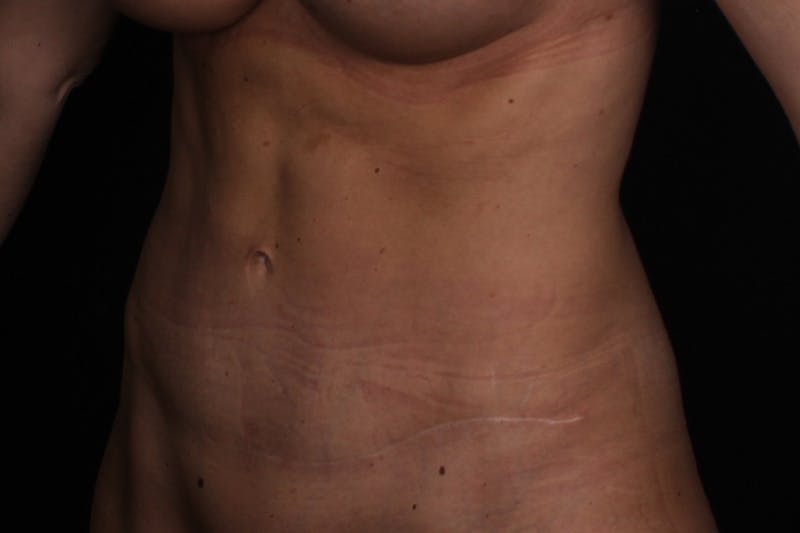 Abdominoplasty Before & After Gallery - Patient 102311 - Image 4