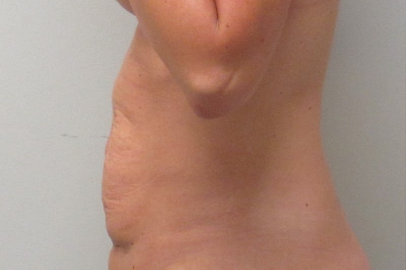 Abdominoplasty Before & After Gallery - Patient 102311 - Image 5