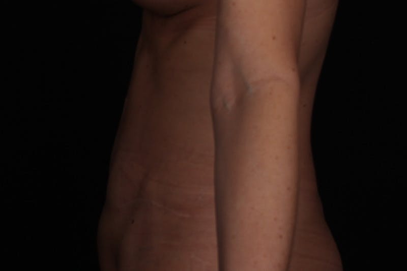 Abdominoplasty Before & After Gallery - Patient 102311 - Image 6