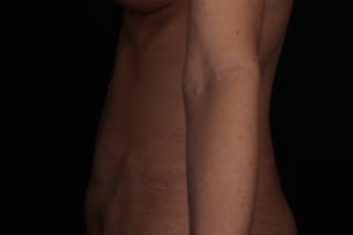 Abdominoplasty Before & After Gallery - Patient 102311 - Image 6