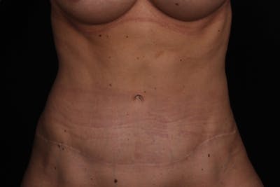 Abdominoplasty Before & After Gallery - Patient 102311 - Image 2