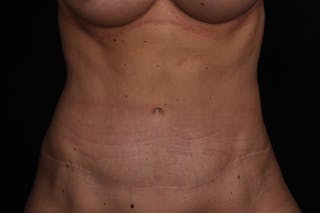 Abdominoplasty Before & After Gallery - Patient 102311 - Image 2