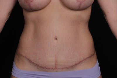 Abdominoplasty Before & After Gallery - Patient 325957 - Image 2