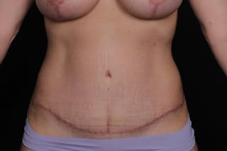 Abdominoplasty Before & After Gallery - Patient 325957 - Image 2