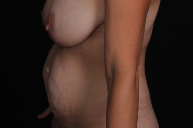 Abdominoplasty Before & After Gallery - Patient 325957 - Image 5