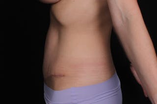 Abdominoplasty Before & After Gallery - Patient 325957 - Image 6