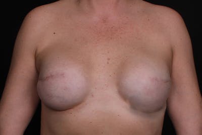 Breast Reconstruction Revision Before & After Gallery - Patient 207912 - Image 2