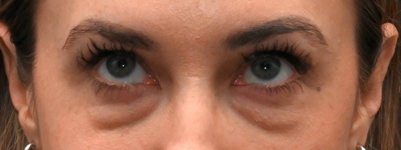 Eyelid Surgery Before & After Gallery - Patient 172420 - Image 3