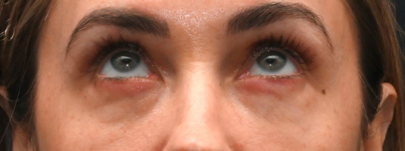 Eyelid Surgery Before & After Gallery - Patient 172420 - Image 4
