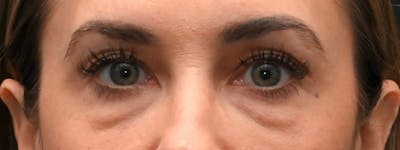 Eyelid Surgery Before & After Gallery - Patient 172420 - Image 1