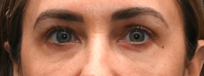 Eyelid Surgery Before & After Gallery - Patient 172420 - Image 2